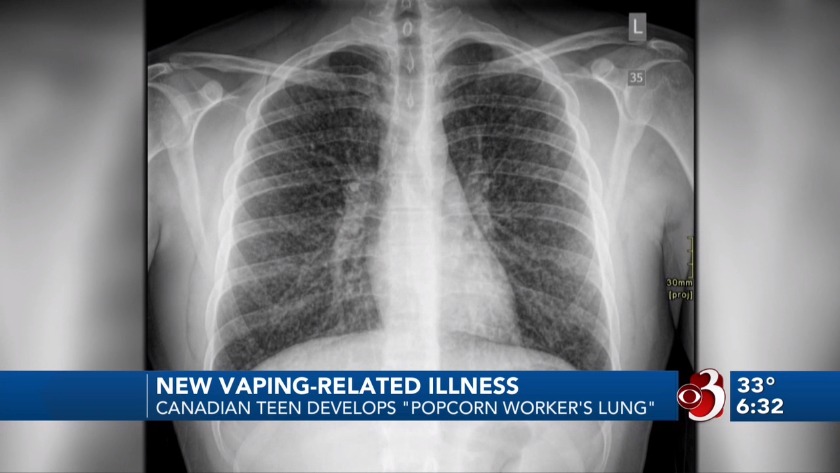 elfbar elfa master akku Truth Behind Vaping and Popcorn Lung main image 0